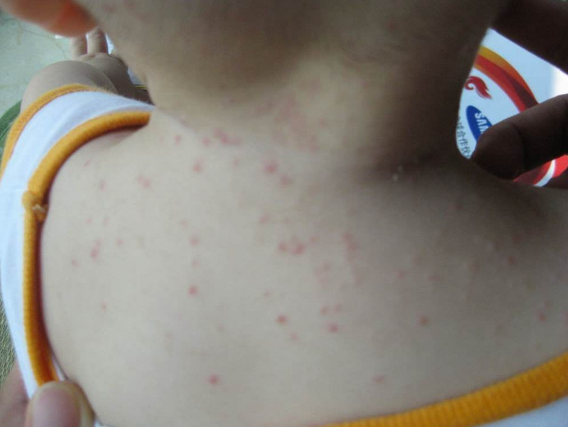 宝宝很容易得湿疹的原因是什么 为什么孩子特别容易起湿疹2018