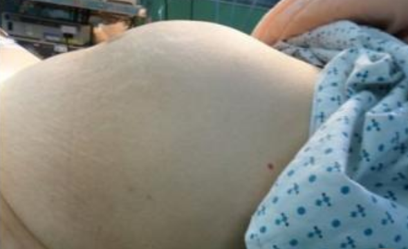 子宫肌瘤对怀孕的影响 子宫肌瘤会导致流产早产吗