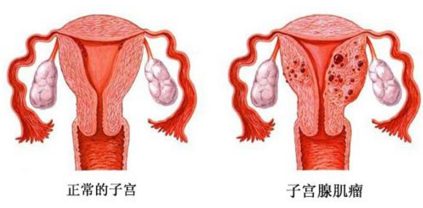 子宫肌瘤对生产的影响 子宫肌瘤会影响胎儿吗