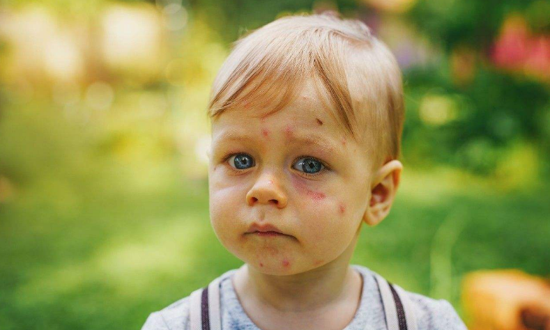 出门怎样防止婴儿被蚊子咬 宝宝在户外怎么防蚊