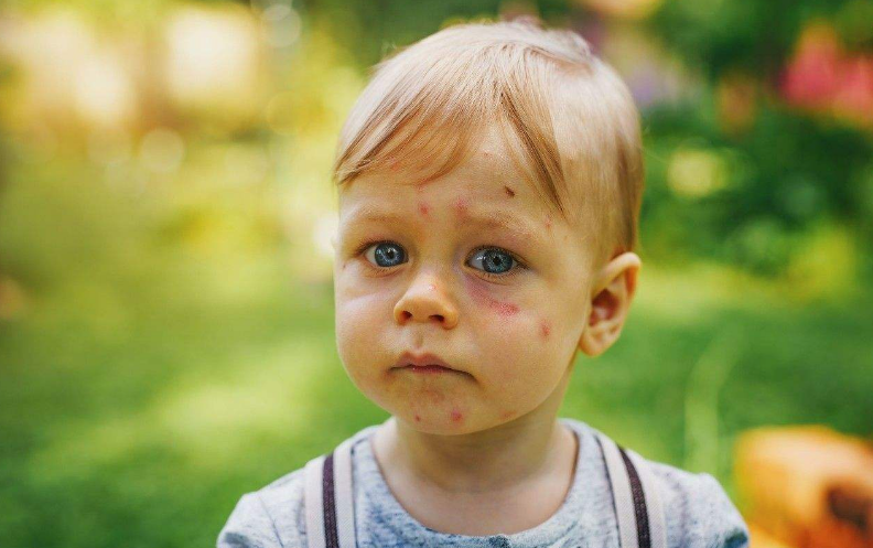 宝宝被蚊子叮咬后红点怎么消除 为什么宝宝蚊子叮咬后红肿