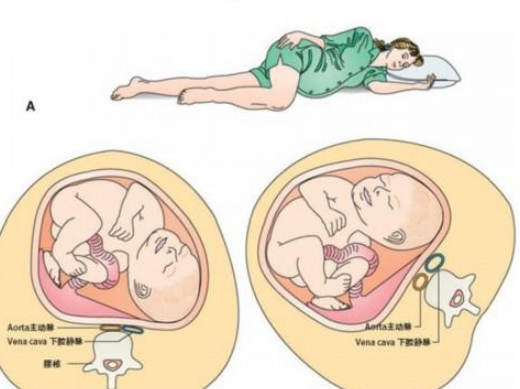 孕妇静脉曲张原因是什么 孕妇静脉曲张怎么预防缓解