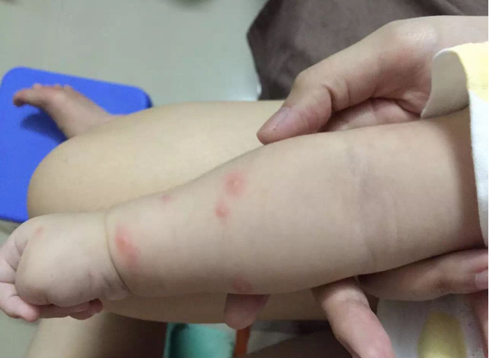 宝宝被蚊子咬红肿几天会消 什么情况下应该送医就诊