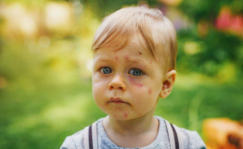 宝宝被蚊子咬红肿几天会消 什么情况下应该送医就诊