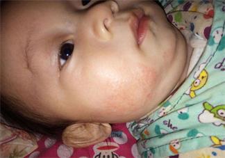 宝宝干性湿疹怎么护理 宝宝干性湿疹护理宝宝方法