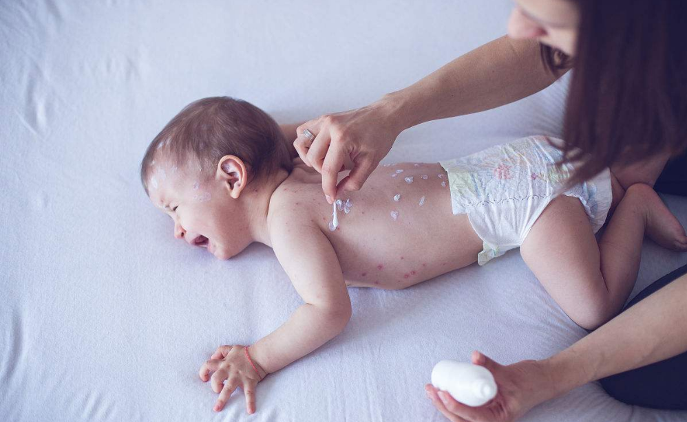 宝宝会将水痘传染给母亲吗 宝宝有什么治疗方法 