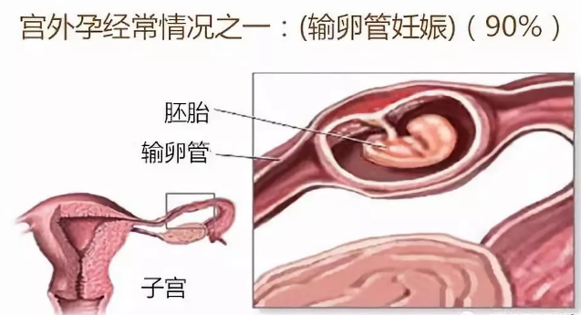 胚胎着床异常就是子宫外孕吗 怎么提早发现子宫外孕2018
