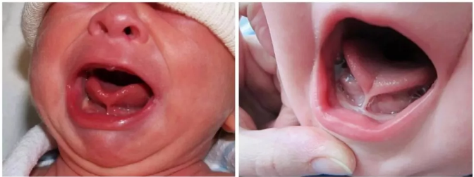 宝宝舌系带短要切吗 怎么判断孩子的舌系带短不短