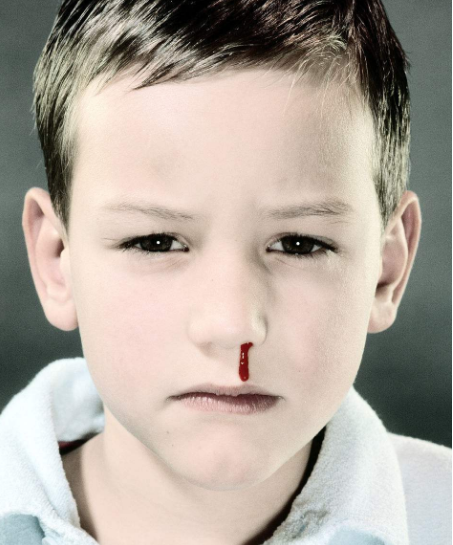 孩子流鼻血是什么原因导致的 怎么预防孩子流鼻血