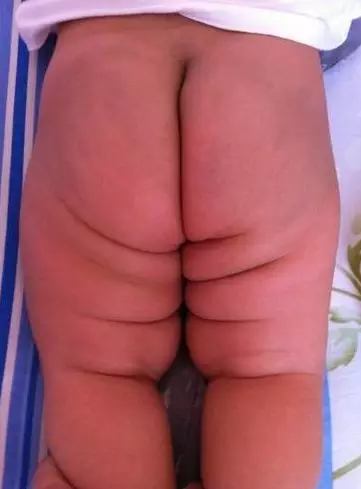 腿纹臀纹不对称就是髋关节不正常吗 孩子腿纹不对称会有哪些影响