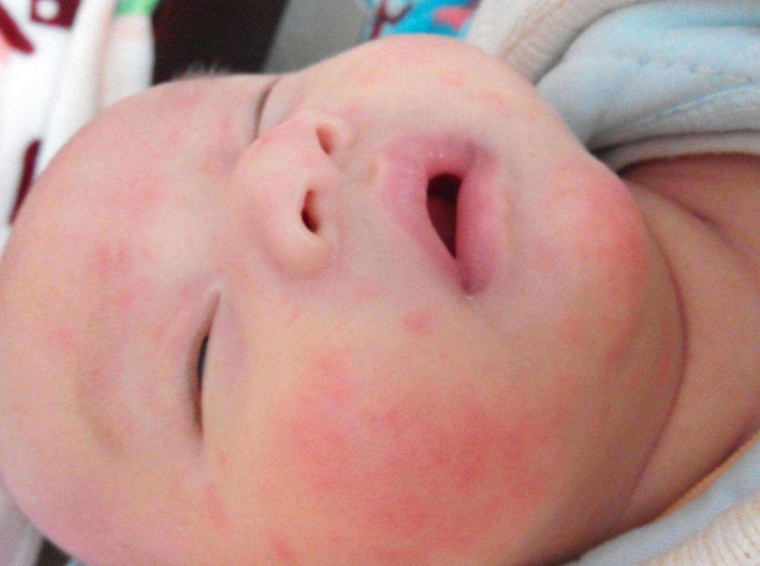 如何有效护理湿疹 怎么不让孩子身上长湿疹