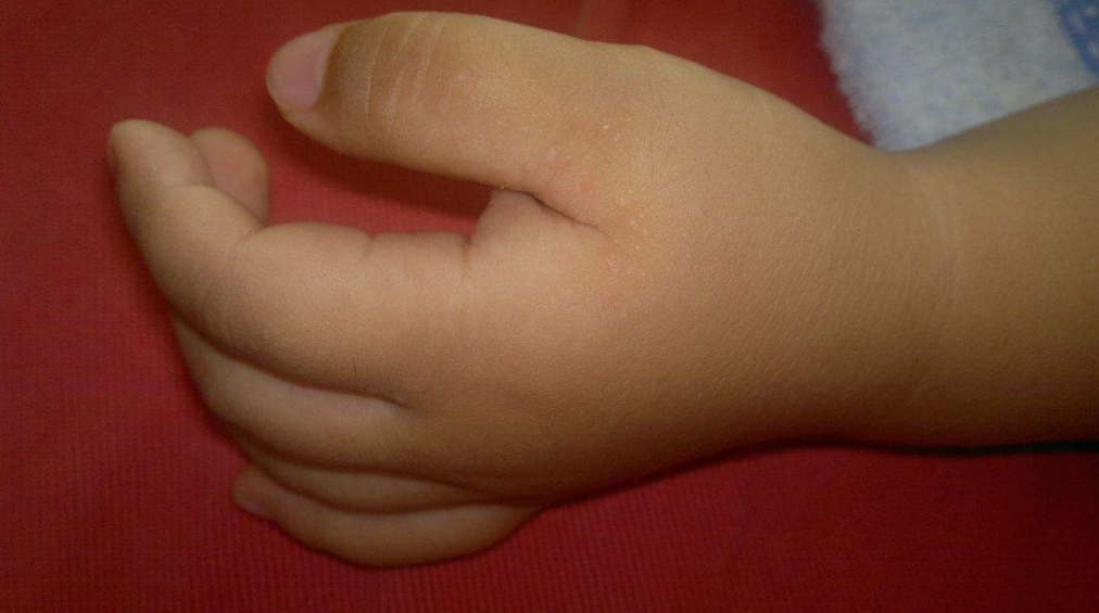 孩子得新型手足口病怎么护理好 孩子新型手足口病正确护理方法