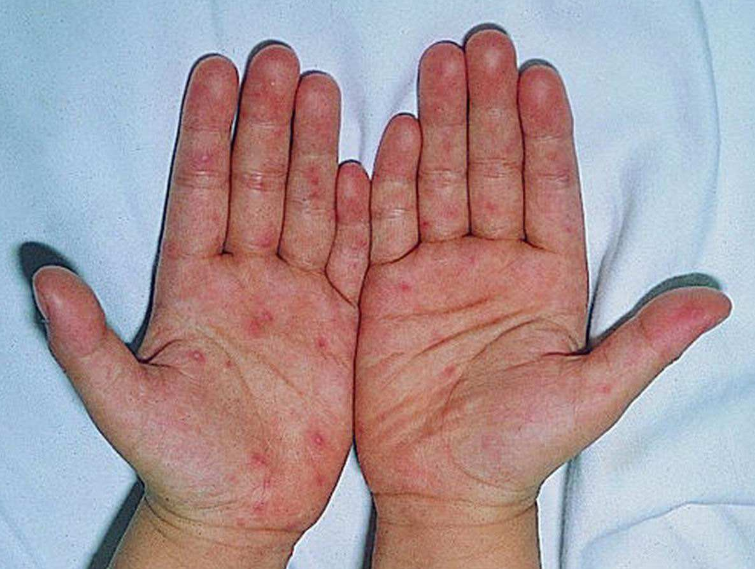 怎么正确的预防手足口病 孩子手足口病情预防方法