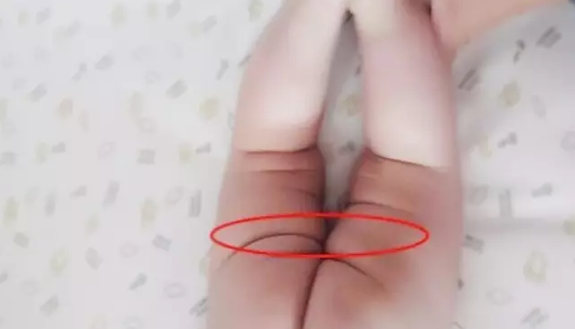 宝宝臀纹不对称是髋关节有问题吗 宝宝臀纹不对称是什么原因