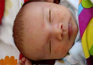 孩子秋季湿疹如何避免 如何帮宝宝对付秋季湿疹