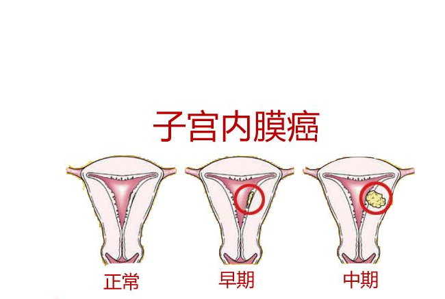 子宫内膜癌做什么检查 如何预防子宫内膜癌