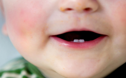 妈妈牙齿不好会遗传吗    牙齿不齐会遗传给孩子吗