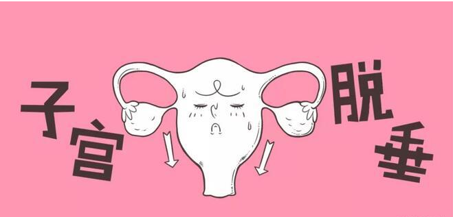 子宫脱垂的有哪些症状 如何预防子宫脱垂