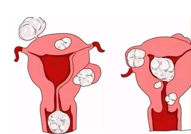 子宫前壁肌瘤影响怀孕吗 患了子宫肌瘤怎么办