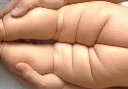 宝宝臀纹不对称是正常的吗 如何预防髋关节脱位