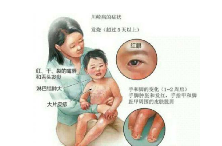 宝宝持续发烧是川崎病吗 川崎病有哪些症状