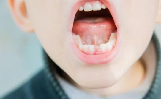 宝宝乳牙蛀牙怎么办  乳牙蛀牙预防指南