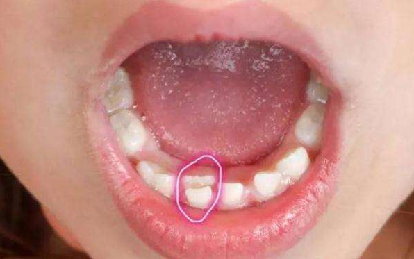 孩子双排牙要不要拔 双排牙的形成原因是什么