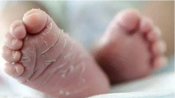 新生儿蜕皮正常吗 新生儿蜕皮护理怎么做