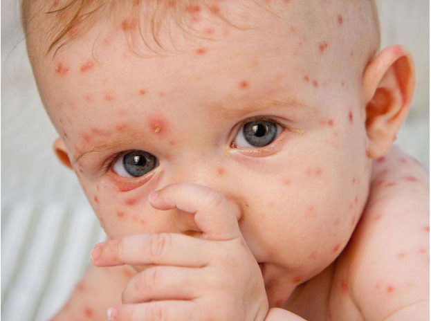 宝宝出了水痘还需要打水痘疫苗吗 宝宝水痘疫苗什么时候打