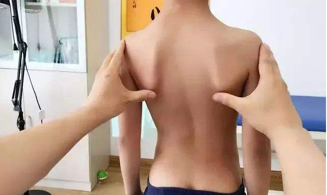 孩子脊柱侧弯是怎么引起的 脊柱侧弯的治疗的黄金时期