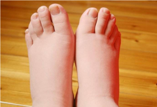 孕妇脚肿可以用热水泡脚吗 如何缓解孕晚期水肿
