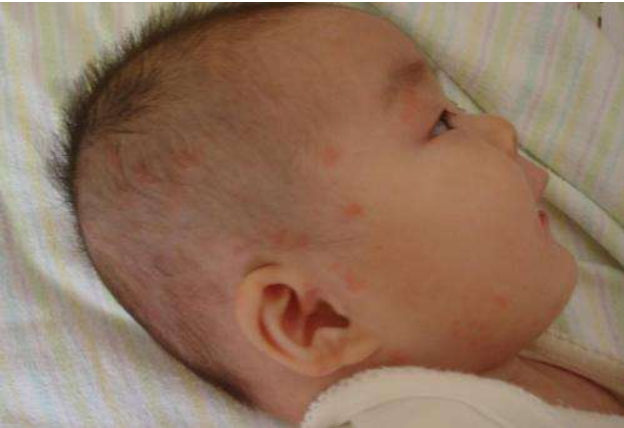 哪些宝宝容易得湿疹 如何预防宝宝长湿疹
