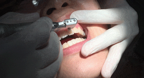 宝宝牙齿涂氟步骤    牙齿涂氟过程介绍