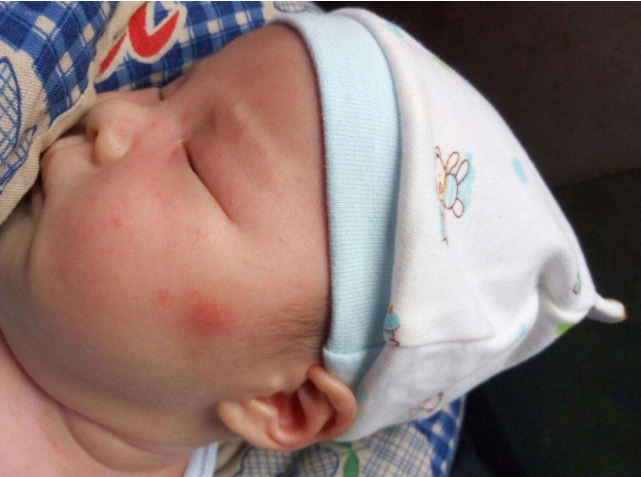 宝宝长湿疹可以打预防针吗 宝宝湿疹怎么护理