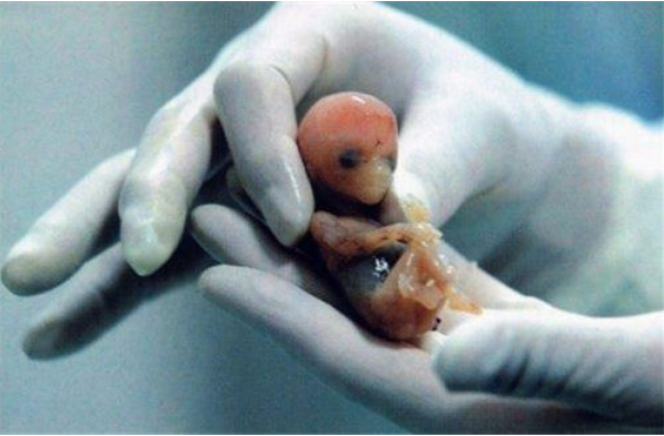 孕期死胎在肚子里能呆多久 孕期死胎是怎么处理的