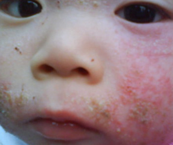 痱子和湿疹的区别 如何防治痱子和湿疹