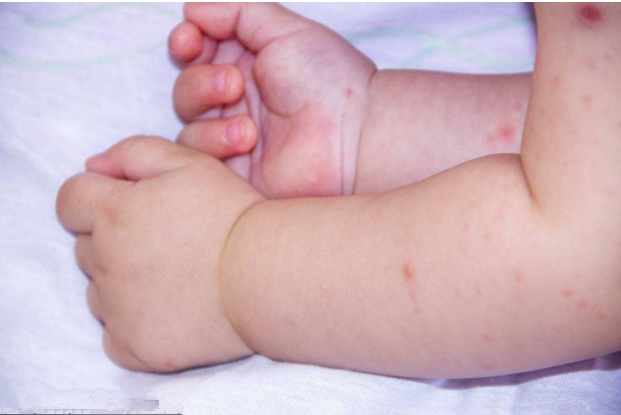 冬季宝宝容易长湿疹怎么办 冬季宝宝长湿疹常见原因