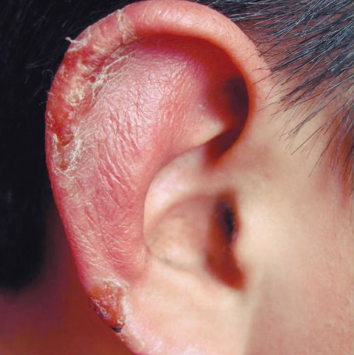 冬至不吃饺子容易冻掉耳朵吗 冬季如何预防宝宝冻耳朵