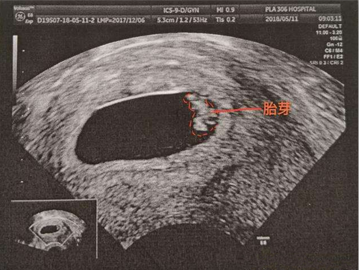 怀孕多久能看见胎芽 怀孕没有看见胎芽怎么办