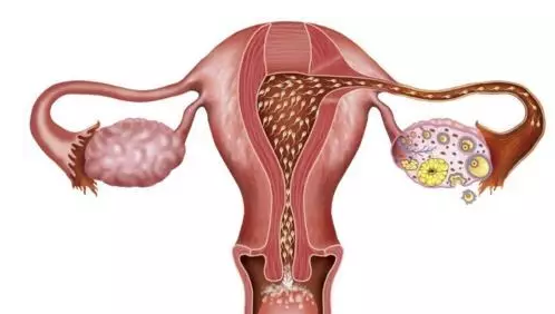 多囊卵巢的症状表现 多囊卵巢有哪些症状