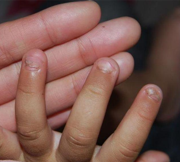 孩子指甲上有黑线是怎么回事 指甲有黑色竖线是得了癌吗