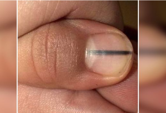 指甲黑线|孩子指甲上有黑线是怎么回事 指甲有黑色竖线是得了癌吗