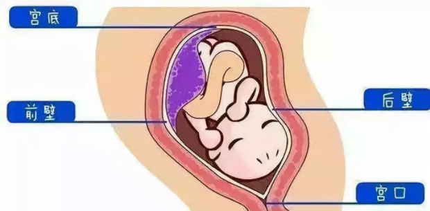 胎盘前置和胎盘前壁是一回事吗 孕期发生胎盘前置怎么办