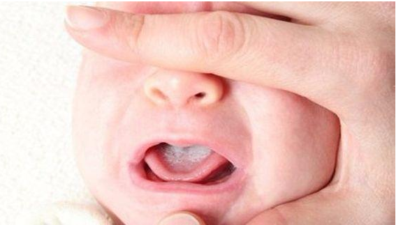 如何分辨奶垢和鹅口疮 宝宝鹅口疮的应对方法
