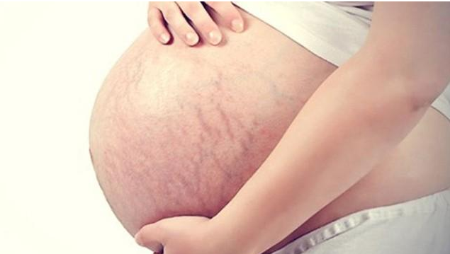 预防妊娠纹的关键时期 孕期长妊娠纹的信号