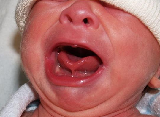 如何判断宝宝是否是舌系带过短 宝宝舌系带过短需要手术吗