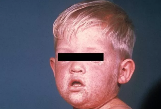 小儿麻疹有哪些症状 儿童麻疹的症状