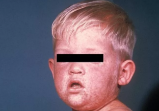 小儿麻疹有哪些症状 儿童麻疹的症状