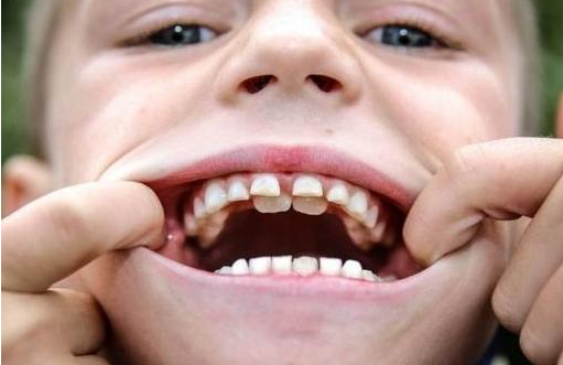 孩子乳牙滞留要拔掉吗 孩子乳牙滞留的常见原因