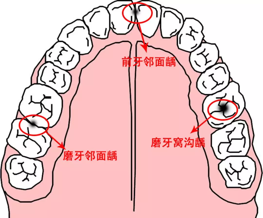 门牙缝隙出现黑点龋洞——邻面龋齿充填一例 - 知乎